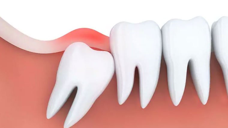 20'lik diş ağrısı enfeksiyona sebep olabilir