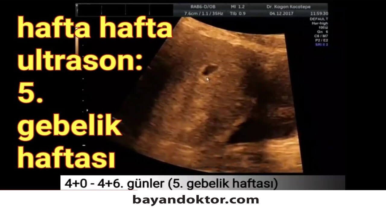 5. Hafta Gebelik – Hafta Hafta Hamilelik