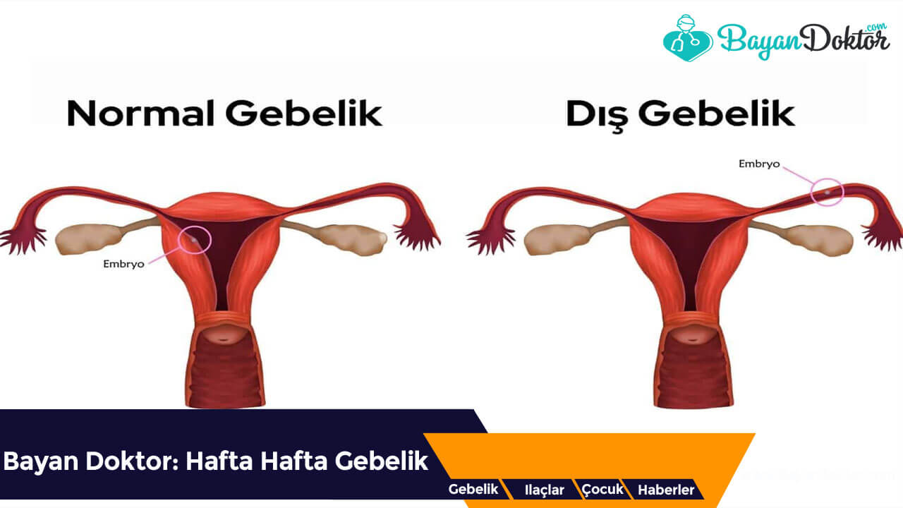 Ektopik Gebelik Nedir?